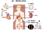 Complication of diabetes　糖尿病の合併症